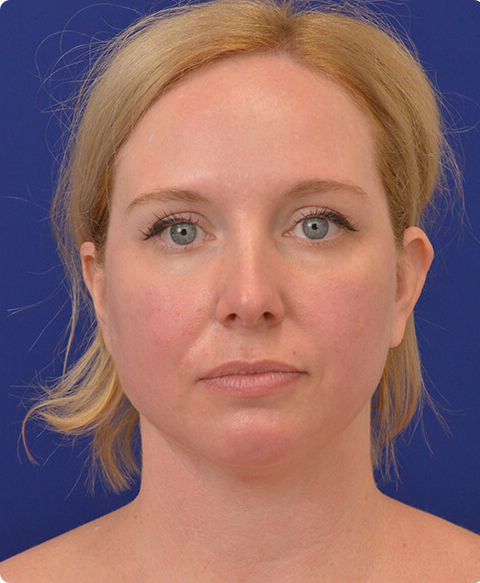 Real patient before facial liposuction procedure