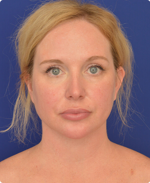 Real patient after facial liposuction procedure