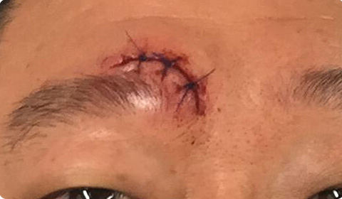 Real patient scar reduction before procedure
