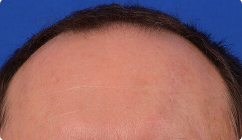 Real patient scar reduction after procedure